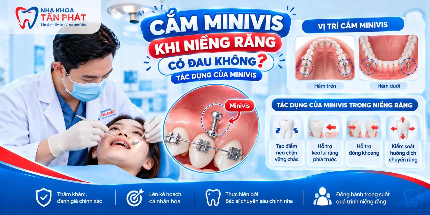 Cắm Minivis Khi Niềng Răng Có Đau Không? Tác Dụng Của Minivis Trong Chỉnh Nha